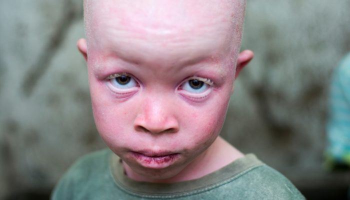 África Austral: Porque defendemos um plano regional para acabar com a morte de albinos